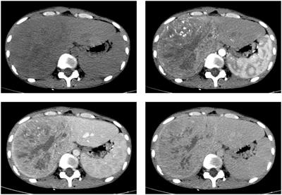 Inflammatory myofibroblastic tumor in the liver: a case report